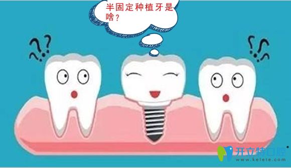 半口半固定種植牙是什么意思