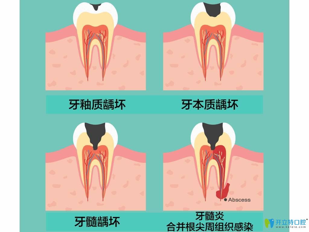 齲齒發(fā)展過程