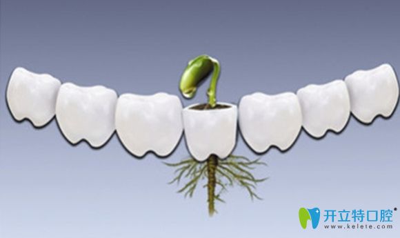 真相探求:種植牙哪個(gè)品牌好?瑞士iti就一定比奧齒泰好嗎?