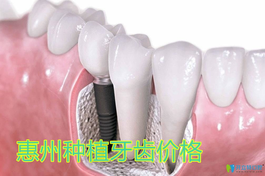 惠州種牙費用