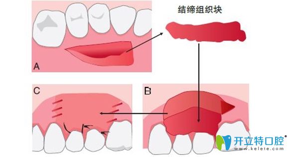 牙齒修補手術(shù)過程圖解