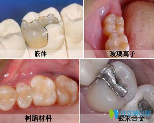 從補(bǔ)牙鑲牙和種牙區(qū)別看哪個(gè)好,種牙滿口多少錢看看all-on-4