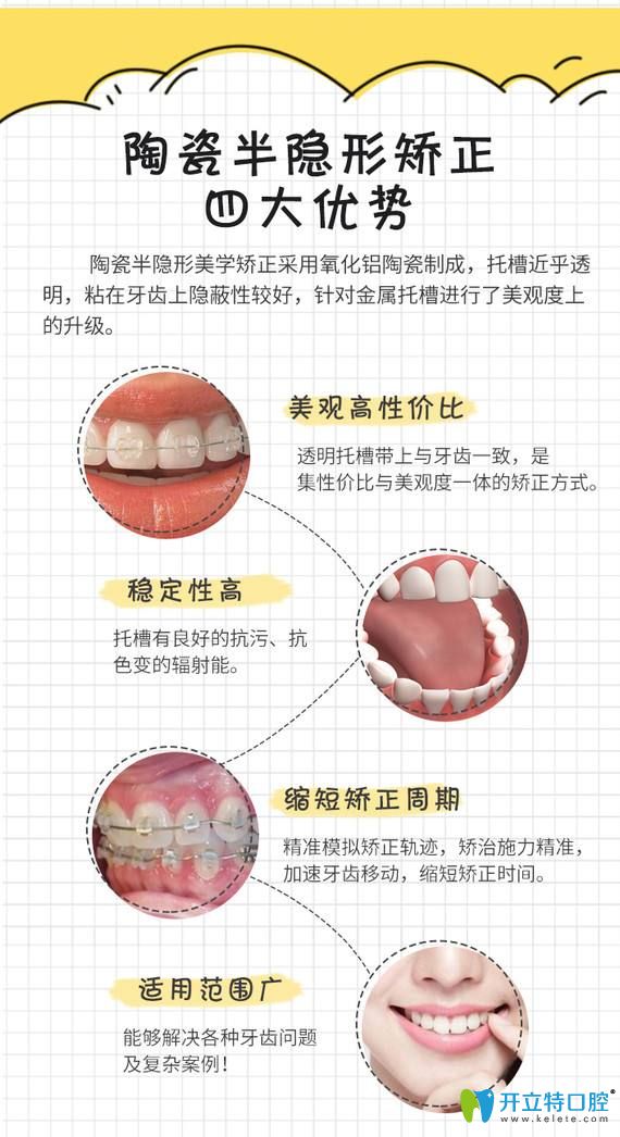 陶瓷半隱形矯正優(yōu)勢(shì)圖