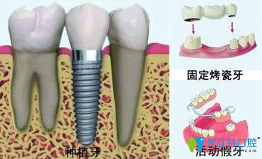 牙齒缺失的修復(fù)方法