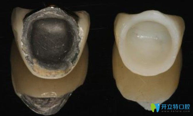 祁凱醫(yī)生解析全瓷牙和烤瓷牙哪個(gè)好