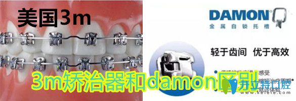 美國damon矯正器與3m的區(qū)別
