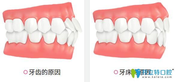 牙齒整齊但嘴巴前凸帶牙套能改變嗎,先區(qū)分骨性和牙性齙牙