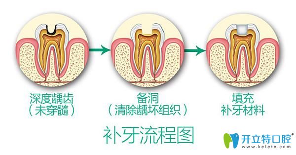 牙壞了3分之二還能補嗎?牙醫(yī)良心忠告,牙壞不能補了怎么辦