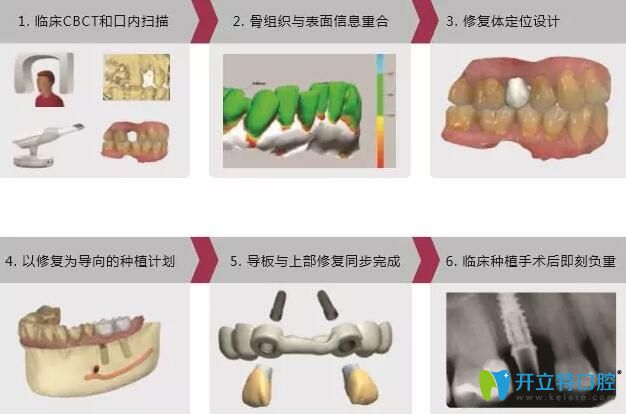 數(shù)字化導板導航種植技術(shù)過程