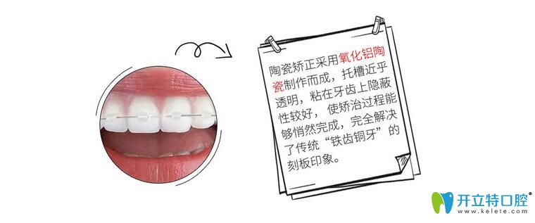 半隱形矯正簡(jiǎn)介