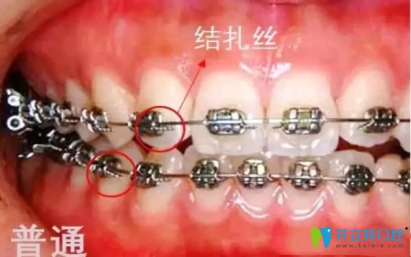 陶瓷非自鎖托槽矯正