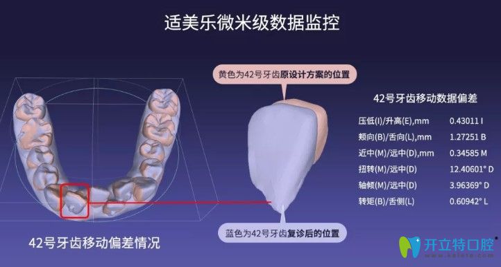 適美樂隱形矯正是國產的
