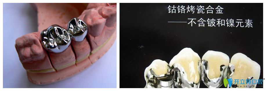 鋼牙比烤瓷牙耐用嗎？看烤瓷牙和鈷鉻鋼牙的區(qū)別