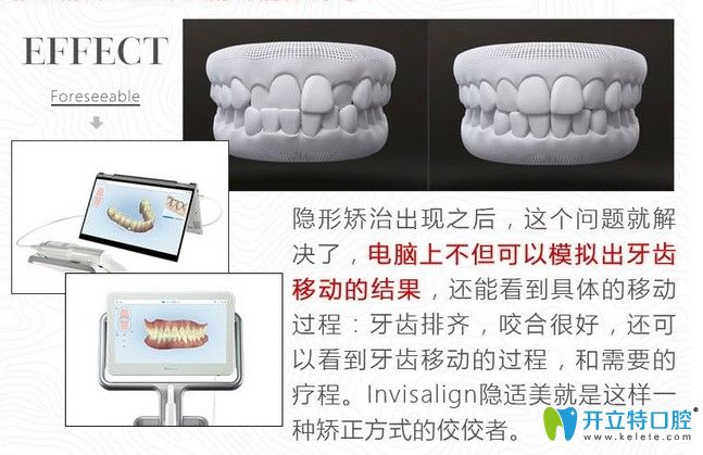 國產(chǎn)隱形牙套和進口的區(qū)別是什么