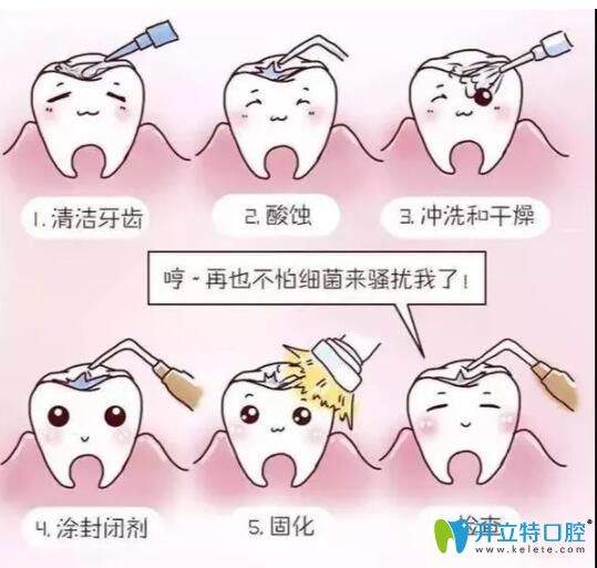 窩溝封閉