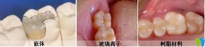 惠州哪里補(bǔ)牙好又便宜,參考牙科比較靠譜的口腔名單及價(jià)格