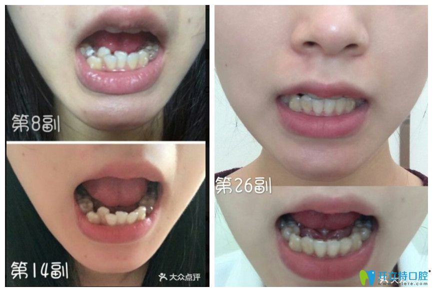 在美萊口腔做時(shí)代天使隱形矯正對比圖