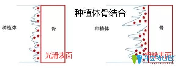種植體與骨結合