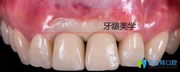 種植體牙齦美學