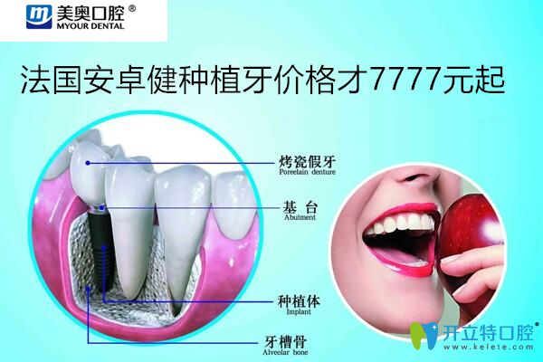 忒狠！聽說上海美奧口腔法國安卓健種植牙價格7777元起