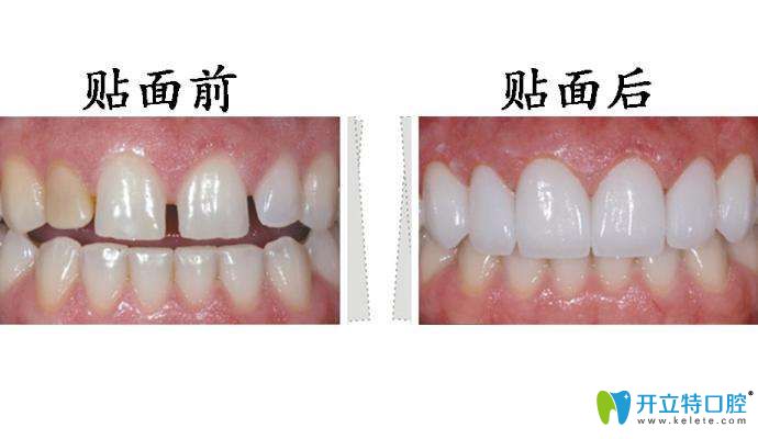 做完牙齒貼面前后對比圖