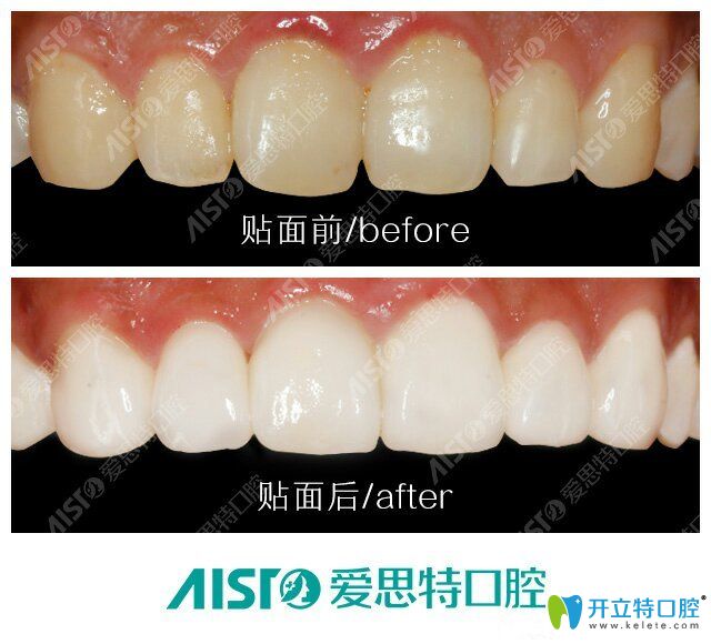 愛(ài)思特口腔牙齒貼面前后對(duì)比圖