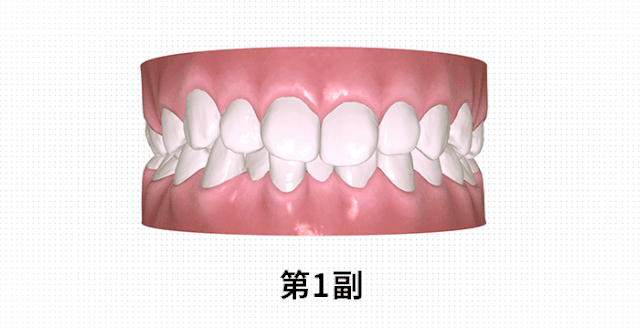 EasySmile牙齒隱形矯正優(yōu)點