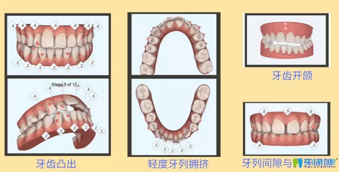 隱適美igo適應人群