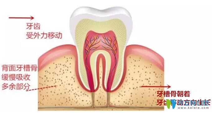 牙齒矯正中牙齒的移動(dòng)原理