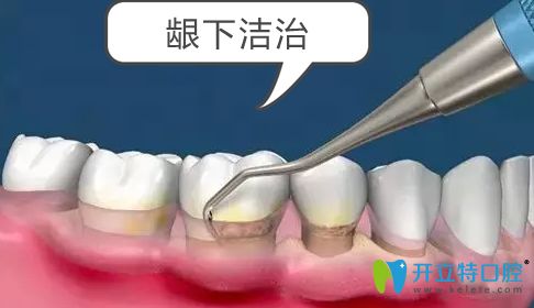 常規(guī)洗牙和齦下深刮治是有效治療牙周病的方法
