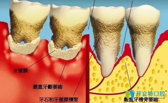 牙周炎加重牙齒就會因此提前脫落