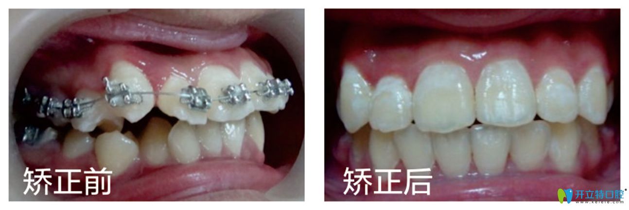 修大夫口腔齙牙矯正前后效果對(duì)比圖