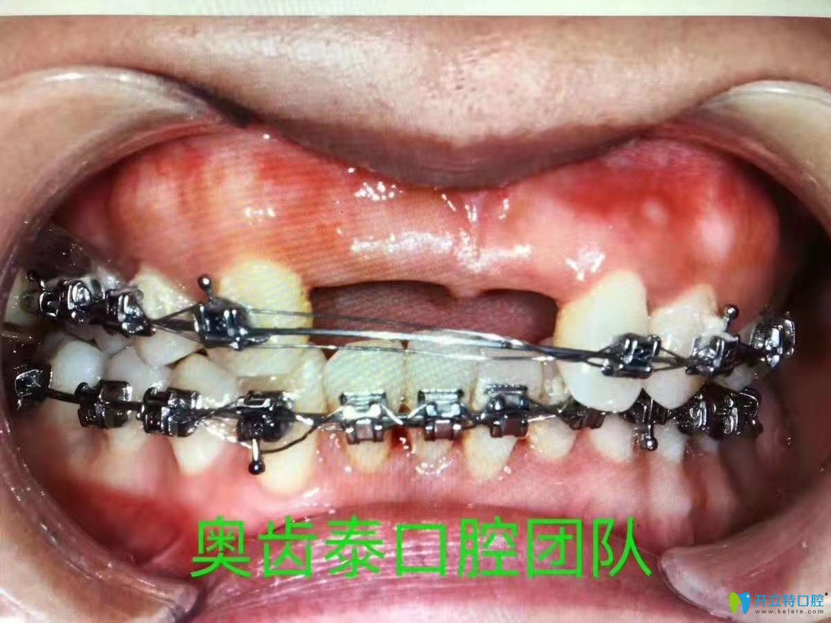 溫州奧齒泰口腔門(mén)診部牙周炎金屬自鎖托槽矯正