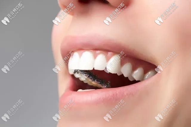 舌側隱形牙套進口和國產(chǎn)的矯正效果有區(qū)別嗎?價格竟差2萬多