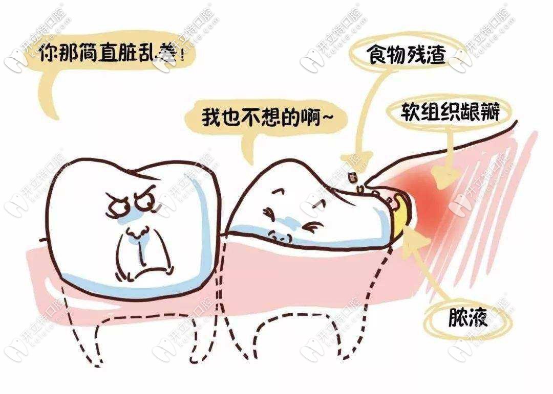 智齒塞牙