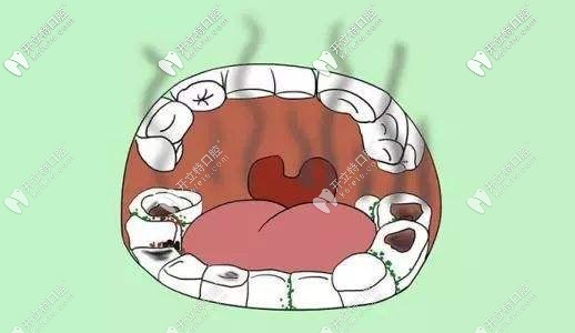 蛀蟲(chóng)塞牙怎么辦