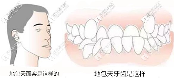 地包天圖片