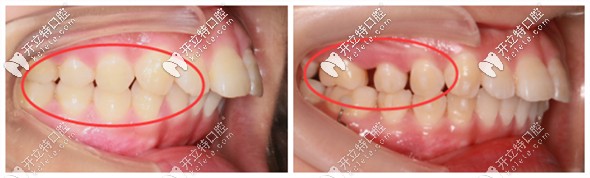 推磨牙的優(yōu)勢(shì)在于減少了拔牙矯正的概率
