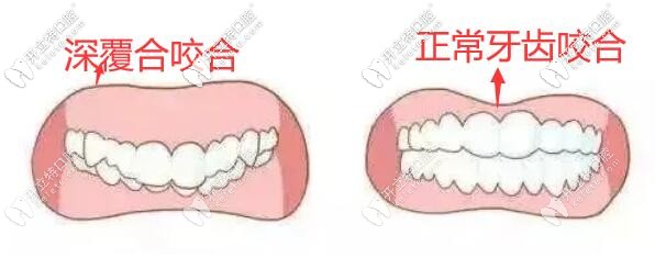 打開深覆合咬合,平導(dǎo)和支抗釘哪個效果好？超詳細(xì)分析