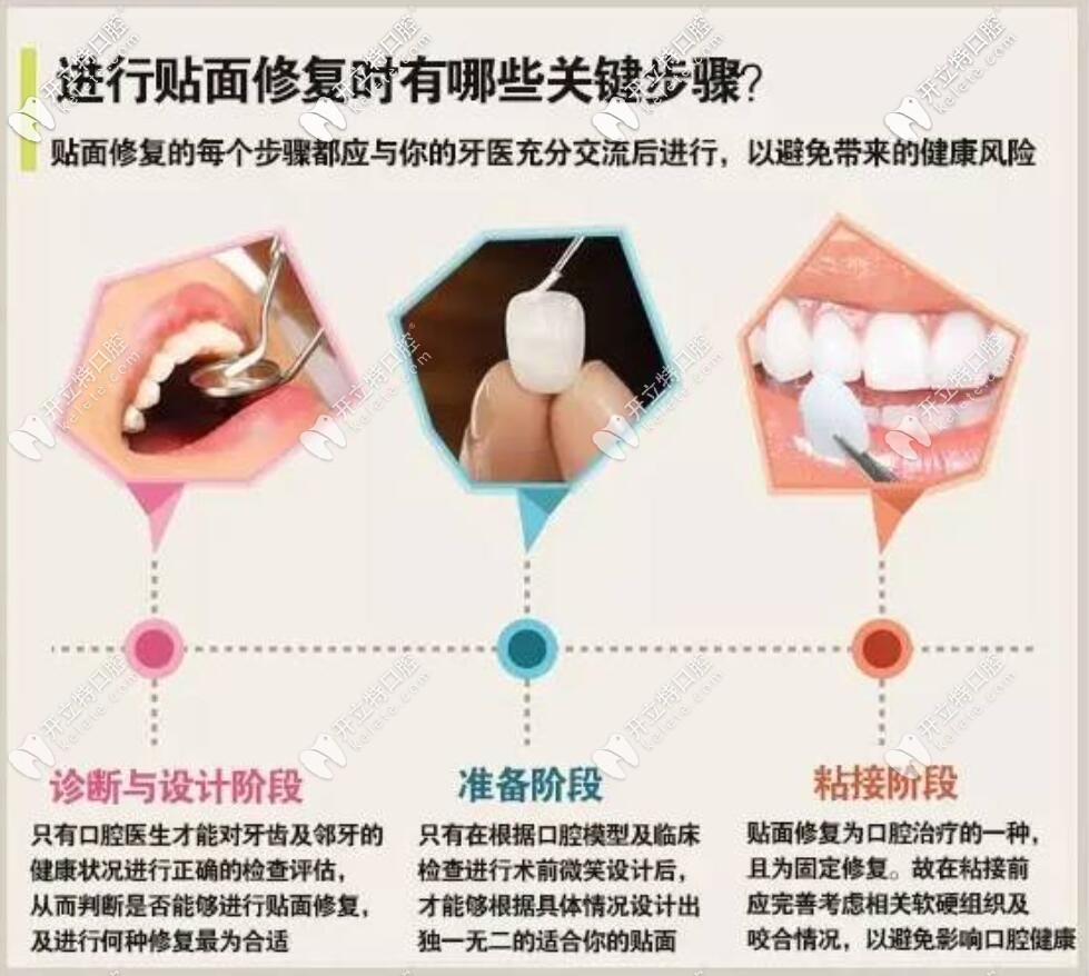 做牙齒貼面設計要點