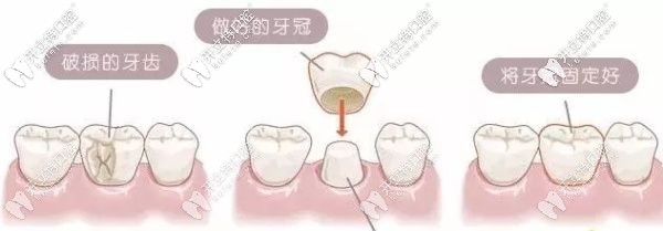 解答：門牙缺了一小塊是選牙齒貼面還是全瓷牙好呢？