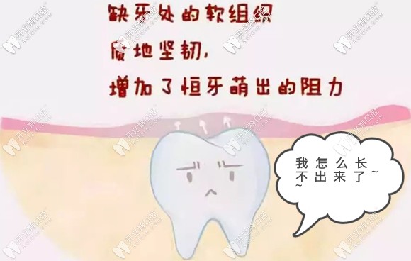 做阻生牙牽引術(shù)成功率高嗎