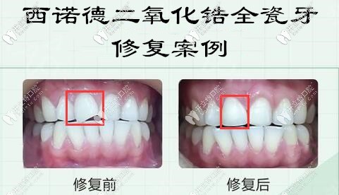 西諾德二氧化鋯全瓷牙修復門牙案例