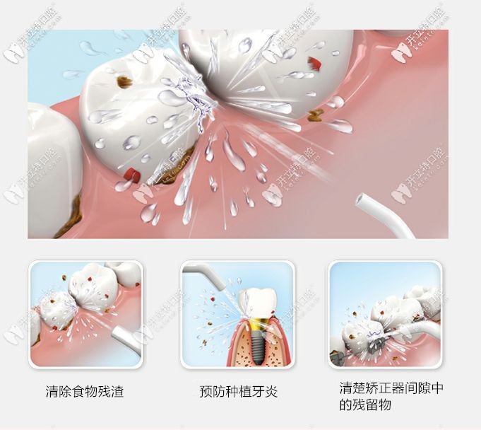 水牙線好處