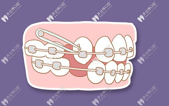 牙齒矯正的移動(dòng)過程 牙齒矯正的移動(dòng)過程