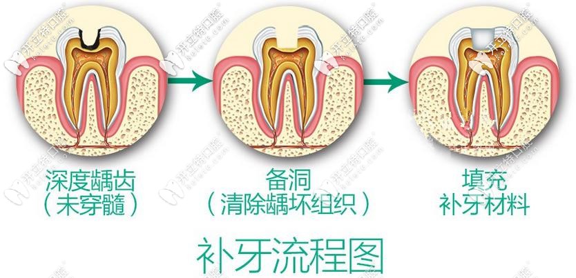 補(bǔ)牙攻略：3m和德國voco納米樹脂補(bǔ)牙哪個材料更好？