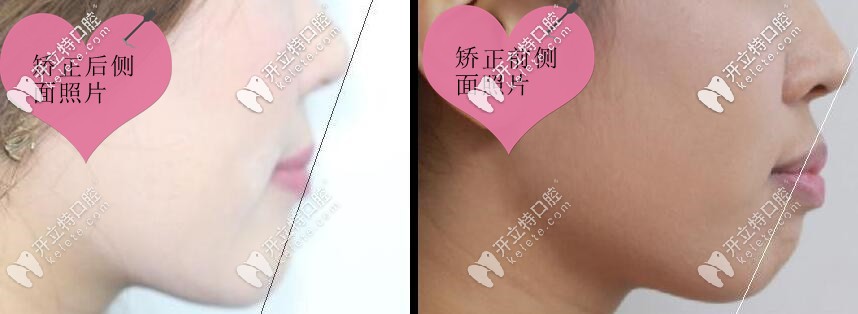 齙牙矯正前后側(cè)面對(duì)比照片