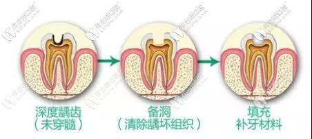 牙齒齲洞較深要做根管治療