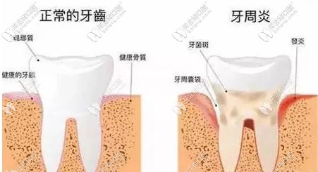 正常牙齒與牙周炎的對(duì)比圖
