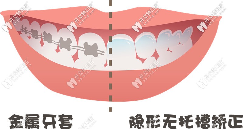 金屬牙套和隱形無托槽矯正
